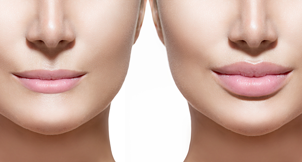 Dermal Fillers